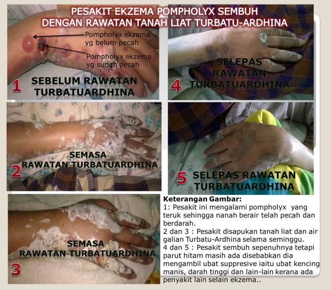 Testimoni Turbatu Ardhina – Ubat Penyakit kulit: TURBATU 